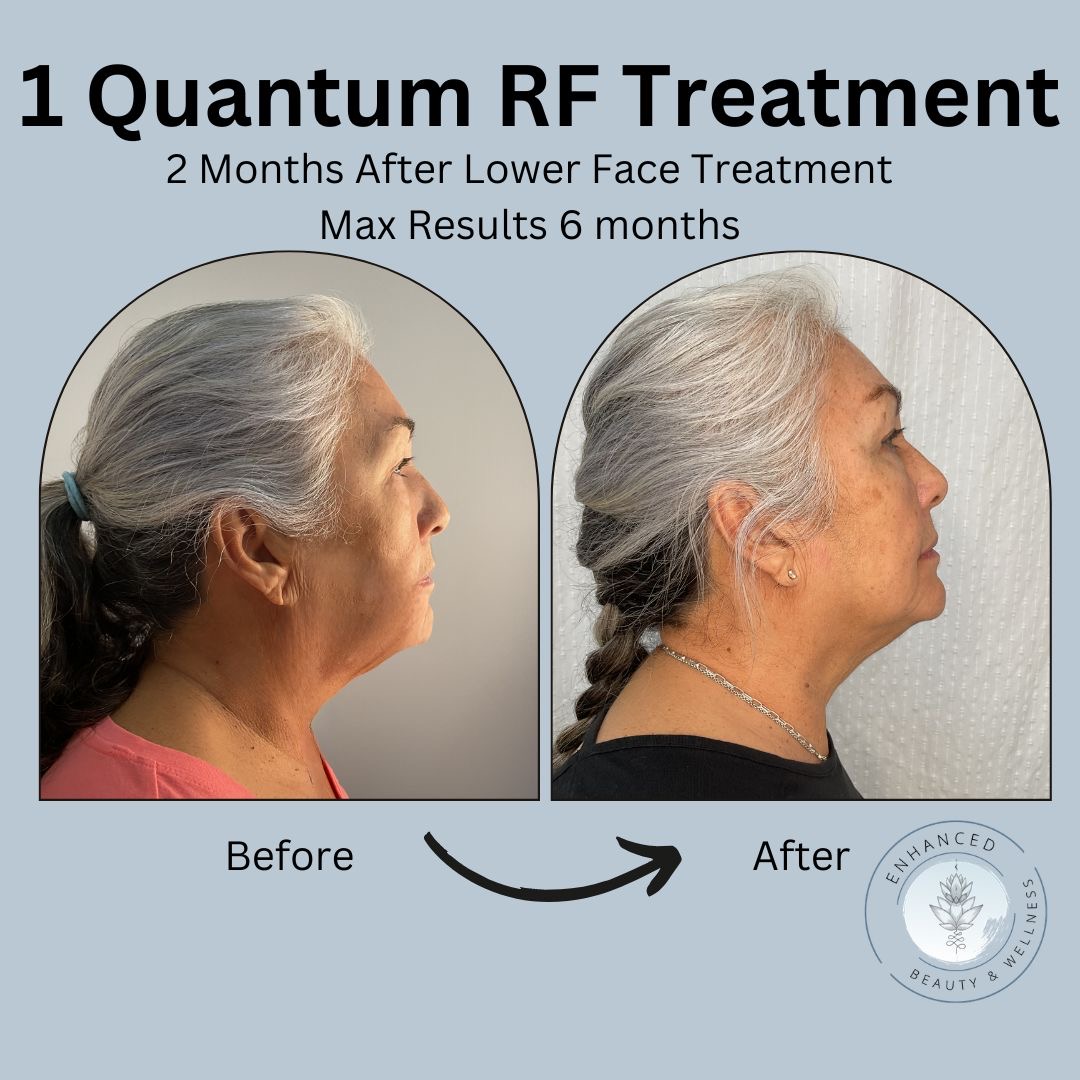 Micro-channels + radiofrequency