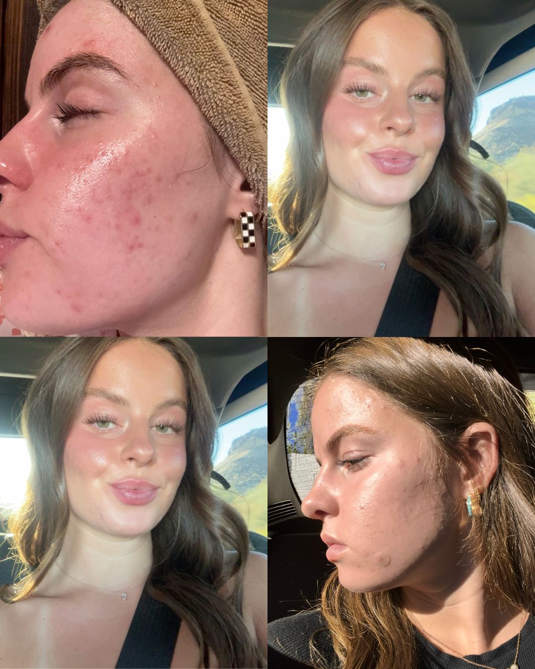 Perfect Derma Peel — customized
